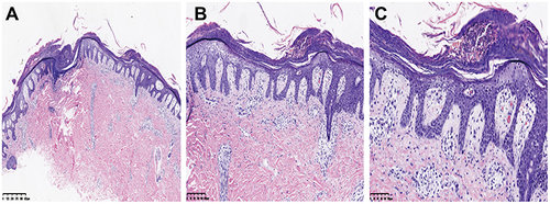 Figure 1 Pathological images. Pathological results showed hyperkeratosis, confluent parakeratosis, Munro microabscesses, acanthosis hypertrophy, regular elongation of the rete ridges, mild spongiosis, papillary dermal edema, mildly dilated blood vessels, scattered perivascular lymphocytes, and neutrophils infiltrated around the upper epidermis and superficial dermis (HE, A ×40, B ×100, C ×200).