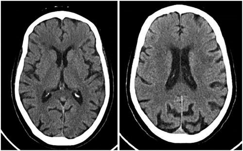 Figure 2. Normal head CT of patient Case 2.