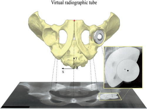 Figure 1. Virtual pelvic radiographs were made using computer simulation. The virtual pelvis was represented by 5 points: the most caudal part of the two teardrops, the most distal part of the two sacro-iliac joints, and the midpoint of the most cranial part of the pelvic symphysis. The virtual total hip replacement was represented by the center of the acetabular cup (marked with a cross-hair) and the center of the femoral head (marked with a circle). The projected distance between these two represents both polyethylene wear and the projected wear direction. Virtual pelvic rotations were performed around the x- and the z-axes, and wear directions were altered in the coronal plane and the sagittal plane. The effects on the virtual wear measurements were then quantified.