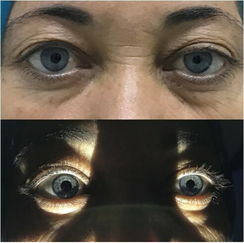 Figure 1 External photograph demonstrating left Horner’s syndrome secondary to a left neck tumor in a 62-year-old woman. Note left ptosis in daylight (figure at the top) and left miosis in the left eye on the right more pronounced in dim light (figure at bottom). An informed written consent was obtained from the patient.