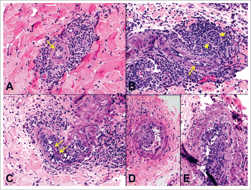 Figure 6. Endothelialitis (v) and chronic allograft vasculopathy (cav). A) Small artery with endothelialitis (v1) (arrow). B) Artery with endothelialitis (arrow) and transmural inflammation in an arteriole (arrowheads) (v3). C) Transmural arteritis (v3). Fibrin (arrows) can be seen in v lesions. D) Early chronic allograft vasculopathy (cav1) in a small artery. E) Severe chronic allograft vasculopathy with luminal reduction (cav3).