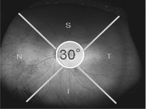 Figure 1 Optos® image of an eye divided into four quadrants.