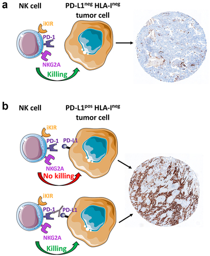 Figure 2. PD-L1 immunohistochemical expression in lung adenocarcinoma and contribution of NK cells in the anti-tumor response against HLA-Ineg tumor cells.