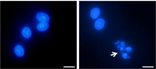 Figure 8 Cells subjected to DAPI (4′,6-diamidino-2-phenylindole) staining, showing condensation of chromatin and nuclear fragmentation (indicated by arrow). Bar, 5 μm. HELA cells treated with naked apoptin (left) and nanoparticles loading apoptin (right).