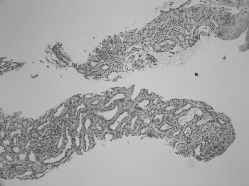 Figure 1. Diffuse tubular dilatation, interstitial edema, and focal interstitial small lymphocyte cell infiltrate without tubulitis. (hematoxylin and eosin; original magnification: ×100). Periodic acid-Schiff stain also reveals attenuation of brush border.