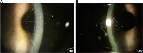 Figure 1 (A) Slit-lamp photograph OD 3 months post-PRK demonstrating Descemet folds (a) and corneal haze (b). (B) Slit-lamp photograph OS 3 months post-PRK demonstrating Descemet folds (a) and corneal haze (b).