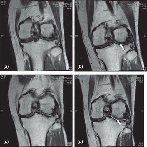 Figure 2. Proton-density coronal magnetic resonance image for patient 007 at baseline (a, c), 3 months (b) and 6 months (d). The appearance of subtle cartilage regeneration is seen in (b) and (d) at the weight-bearing portion of the lateral femoral condyle, as indicated with the arrow.