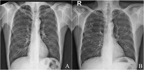 Figure 1. An example of a PA chest X-ray images of a patient who underwent bilateral EBCT procedure.
