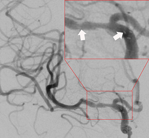 Figure 2 A 4×16 mm Enterprise stent was implanted to accurately cover the stenosis (white arrows show the distal and proximal markers of the stent).