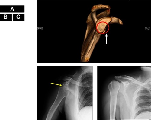 Figure 1 Shoulder dislocation in Patient 2. A normal glenoid cavity conforms to the red circle. The anterior edge of the glenoid cavity is straightened (white arrow) indicating bone defect, at the 2:00–6:00 position (A). The humeral head (yellow arrow) is displaced downward (B). The humeral head has been repositioned and returned to its original position (C).