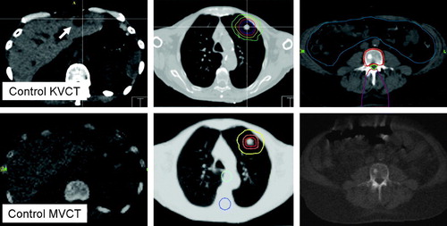 Figure 2.  Volumetric CT based image-guidance for liver, lung and spinal targets. The top row depicts image-guidance provided by the simulation kilovoltage CT scanner (KVCT). The lower figures show the corresponding megavoltage CT (MVCT) images acquired on the helical tomotherapy unit. The arrow indicates the liver metastasis in KVCT imaging. Depicted here are the various strategies to evaluate patient setup for image-guidance. Image-data are co-registered to the original simulation imaging and corrective shifts can be derived by assessing the fit between the imaging studies, and/or superimposing isodose distributions or structure outlines onto the control CT scan.