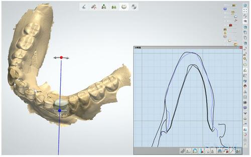 Figure 6 Adjustment of the crown contour. Blue line: Tooth outline of the pre-preparation scan. Black line: Design outline of the zirconia crown.