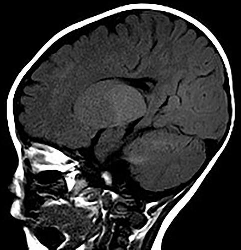 Figure 6 Sagittal MRI images at age of 9 months showing displayed diffusely and symmetrically abnormal signal in the white matter in bilateral cerebral hemispheres, cerebellar.
