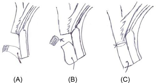Figure 1 Skin and muscle surgery: (A) Skin incision was done 3–4 mm away from the lid margin covering the lateral 2/3 of lid width. (B) Incision in the orbicularis muscle (muscle layer) was made. A strip of orbicularis oculi was excised. (C) Closure of the muscle layer with 6/0 Coated VICRYL (interrupted stitches) was done. Closure of the skin with continuous 6/0 Coated VICRYL was done.