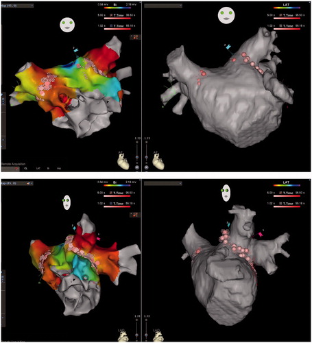 Figure 2. CARTO voltage maps (left) and CT images (right) of the LA in a patient with persistent AF who underwent 2nd ablation in the RMN group, AP (upper) and LAO (lower) views respectively, showing again detailed reconstruction of the PV antrum as well as reconnections to the antero-inferior right upper and antero-inferior right lower PV where RF applications were added to re-isolate these PVs. RF ablations were also conducted against recordable local electrograms along the ridge between the atrial appendage and the left PVs in order to abolish potential substrate for re-entry, even reconnection was not identified to the left PVs.
