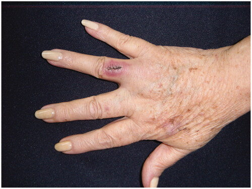 Figure 3. MCC on the fourth right finger. 