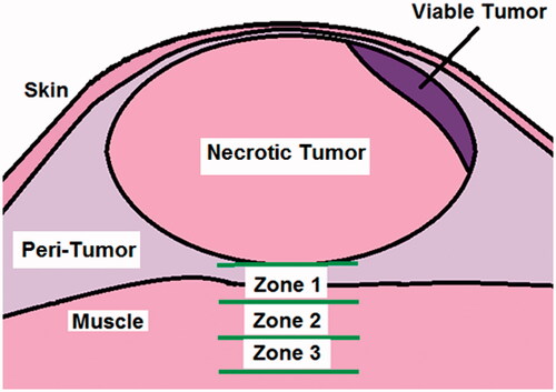 Figure 5. This figure represents the histological parameters used to assess a treated mouse tumour and associated normal tissue deep to the tumour. Zones 1, 2 and 3 were used to determine and quantify the morphological tissue response at various depths beneath the tumour following treatment. Each zone had a thickness of 0.75 mm. Zone 1 started at the deep edge of the tumour. A quantitative cross-sectional area method was used to determine the relative amount of viable versus non-viable tumour area. The presence of normal tissue/muscle necrosis, peritumoural oedema and/or haemorrhage was categorised for each of the three zones for each tumour.
