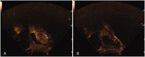 Figure 2. Contrast-enhanced ultrasound images before and after HIFU ablation (sagittal). (A) The gestational sac (blue arrow) and blood flow (red arrow) were presented on transabdominal color Doppler contrast-enhanced ultrasound before HIFU ablation. (B) Contrast-enhanced ultrasound showed the gestational sac was deformed (blue arrow) and blood perfusion was significantly reduced (red arrow) after HIFU ablation.