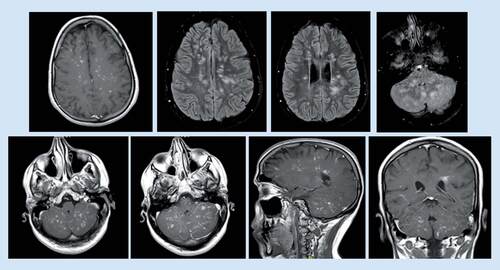 Figure 3. MRI brain revealed progressive changes of the previously noted abnormal signal intensity at brain stem, cerebellum and bilateral parietal white matter, with significant enhancement at postcontrast study (January 2017).