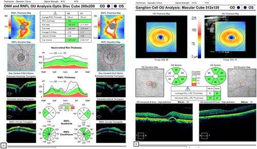 Figure 8 (A) OCT of the optic nerve head shows optic nerve edema in the left eye, with crowded disc (0.029) in the fellow eye. (B) Ganglion OCT shows no abnormality in both eyes.