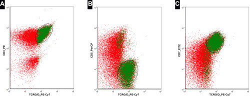 Figure 5 Flow cytometry of T-cell large granular lymphocytic leukemia in bone marrow (2018) shows CD3+/TCR γδ+ (depicted in green) (A), CD5−/TCR γδ+ (B), and CD7+/TCR γδ+ (C) expression.