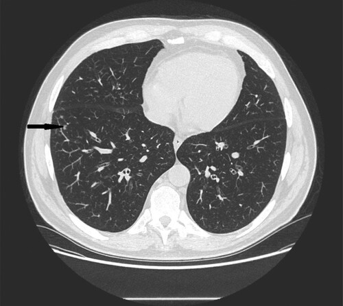 Figure 6. 56-year-old male with primary myeloid fibrosis 30 days after bone marrow transplantation presenting with fever. High resolution CT scan obtained at level of lower lobes shows peripherally located nodules with halo sign in right lower lobe (black narrow arrow).