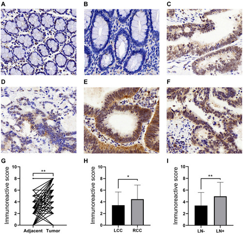 Figure 1 The expression of TIPE in different samples. (A) Representative immunohistochemical staining showed low TIPE expression in left-side adjacent normal tissue. (B) Representative immunohistochemical staining showed low TIPE expression in right-side adjacent normal tissue. (C) Expression of TIPE in tumor tissues without lymphatic invasion. (D) Representative immunohistochemical staining showed high TIPE expression in left-side colon cancer. (E) Representative immunohistochemical staining showed high TIPE expression in right-side colon cancer. (F) Expression of TIPE in tumor tissues with lymphatic invasion. (G) Before–after plot showing the immunoreactive score (IRS) of paired tumor tissue and adjacent normal tissue for TIPE. (H) The IRS of TIPE expression in LCC and RCC. (I) IRS of TIPE expression in colon cancer specimens with or without lymph node metastasis. *P<0.01; **P<0.0001.