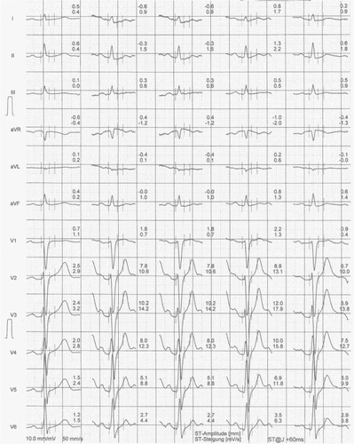 Figure 4 Exercise ECG from brother B.