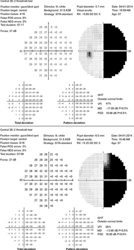 Figure 1 Humphrey visual field for patient 1 showing gray scale image and total and pattern deviation demonstrating dense right homonymous hemianopsia.