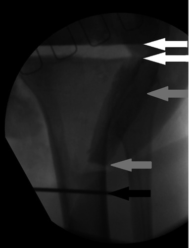Figure 3 Intraoperative radiograph showing the intra-articular bone resections made parallelly to the preexisting joint obliquity (white arrows), osteotomized tibial tubercle (gray arrows), and insertion of Kirschner wire in the area of the planned tibial osteotomy (black arrow).