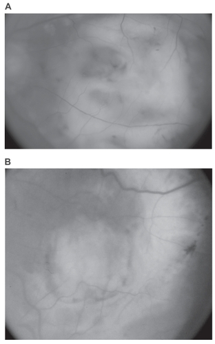 Figure 3 Disciform scars in 2 fellow eyes from the subgroup of 14 patients. A) Fundus picture of the largest scar that developed without previous intervention. B) Fundus picture of the largest scar that developed following previous laser treatment. This eye had received 2 sessions of laser photocoagulation for CNV.