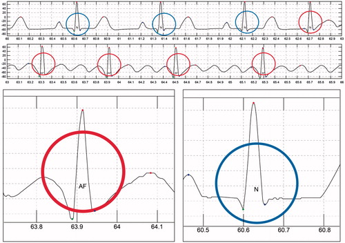 Figure 9. Automatic ECG detection results for atrial fibrillation (AF).