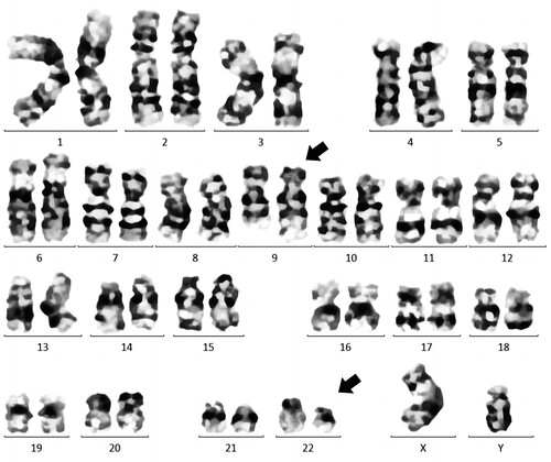 Figure 1. Cytogenetic analysis of bone marrow aspiration showing a karyotype 46,xy,t (9;22) (q34;q11). A gene translocation occurred between chromosomes 9 and 22 resulting Philadelphia chromosomes at the sites as indicated with arrows.