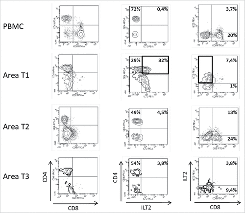 Figure 1. Representative dot plots of the results obtained by flow cytometry analysis for ILT2 cell-surface expression on CD8+ and CD4+ T cells from PBMC and 3 different tumor areas in patient #7 are shown. Tumor-infiltrating cells were obtained after mechanic disruption followed by enzymatic digestion of 3 different areas from the surgically-resected tumor (T1, T2, T3). PBMC and tumor infiltrating cells from each tumor area were stained with conjugated-antibodies directed against CD3, CD4, CD8, and ILT2 and were then analyzed by flow cytometry. Percentages of both ILT2-positive and ILT2-negative populations gated on CD3+ T cells are indicated.