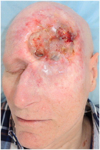 Figure 2. Erosive ulcer in the left periorbial region in 2015 after vismodegib treatment.