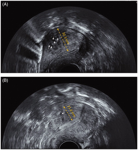 Figure 1. Two-dimensional transvaginal ultrasonography imaging of uterus by GE Voluson E8 color flow ultrasound machine. (A) Before HIFU treatment, the muscular layer of the anterior wall of the uterus was significantly thickened (30.3 mm, yellow bipolar arrow); with multiple hyperechoic striations and tiny myometrial cysts (white arrows) in the interior. Endometrium was asymmetric. (B) Three months after HIFU treatment, the muscular layer of the anterior wall of the uterus was significantly thinned (21.6 mm, yellow bipolar arrow); with few hyperechoic striations and tiny myometrial cysts (white arrow) in the interior. Endometrium was symmetric.