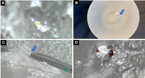 Figure 10 (A–D) Evaluation of the breast implant. Microscopy of the implant’s interior with a 1600× magnification showing signs of chemical reaction of the internal content, with droplets inside the implant (yellow asterisk) (A). Macroscopic assessment shows that the implant is intact (B). The transition surface between the textured and smooth surfaces on the implant seal shows fissured detachment of the surfaces with exposure of the internal content (blue arrow). The interior of the implant also shows changes in color, with a cloudier appearance containing foreign bodies (x green) (C). At the surface transition, deterioration of the implant surface is visible with hematic material in between (brown triangle) (D).
