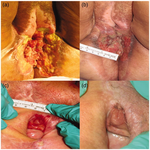 Figure 3. Pre- and post-treatment vulvar recurrence. The picture showed the significant improvement of the lesions one month later after the treatment (a, b), the skin was pale and regular (c, d).
