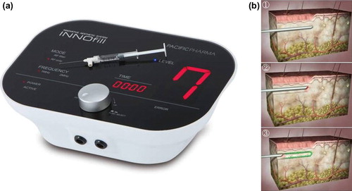 Figure 1. (a) Novel minimally invasive radiofrequency device. (b) Procedure: (Citation1) Insertion of the needle into the scar at variable depths from the superficial to mid-dermis (Citation2) ‘in situ’ 360 degree rotation (tunneling) performed to create a virtual canal contextually supplying the radiofrequency (Citation3) Repetition of the procedure in retrograde using a multi-prick technique along the scar.
