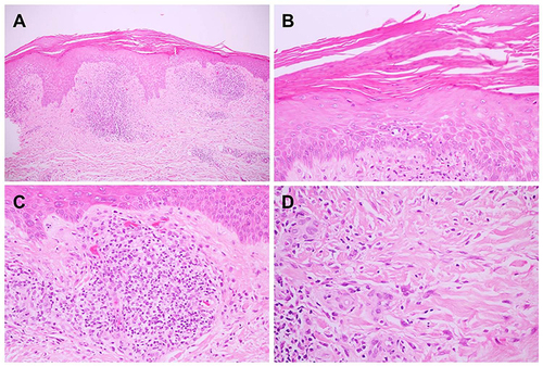 Figure 3 Histopathological findings (hematoxylin-eosin): (A) epidermal hyperplasia with flattening of rete ridge (original magnification x40) and (B) hyperkeratosis with parakeratosis (original magnification x100), (C) plump endothelial cell-blood vessels with dense superficial perivascular cell infiltration (original magnification x100), (D) interstitial infiltration of stellate fibroblasts (original magnification x600).