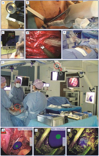 Figure 4. Multiplexing modalities for radioguided surgery combining gamma and fluorescence detection. (a) Optonuclear probe design with detection elements for both low-to-mid energy gamma tracing and ICG fluorescence tracing (from [Citation220]). Application during open surgery breast cancer (b–c) and laparoscopic surgery cervix cancer (d) SN procedure using ICG-99mTc-nanocolloid (from [Citation221]). (e) Position tracking and navigation of an open surgery fluorescence camera during a penile cancer SN procedure using ICG-99mTc-nanocolloid. (f) Similar navigated fluorescence camera setup for a laparoscopic prostate cancer SN procedure (from [Citation179]). (g–h) The fluorescence laparoscope is guided towards the lesion locations via augmented reality overlays of the freehand SPECT scans. (i) Fluorescence confirmation of the lesion of interest.