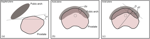 Figure 4. Measuring methods of pubic arch interference (PAI). (a) Angle (α) between pubic symphysis and ventral border of prostate, (b) Orthogonal distance (Δs) from inner surface of pubic arch to ventral border of the prostate and (c) Prostate diameter blockage (d1) by the pubic arch compared to total prostate diameter (D).