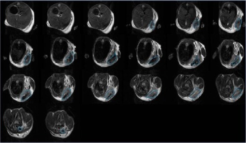 Figure 10 The coronal sections of the tumor from the right armpit of mice.