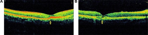 Figure 2 Optical coherence tomography (OCT) of choroidal rupture involving fovea.