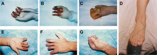 Figure 1 Male patient, 21 years old, with degloving damage involving four digits caused by machine-related trauma.