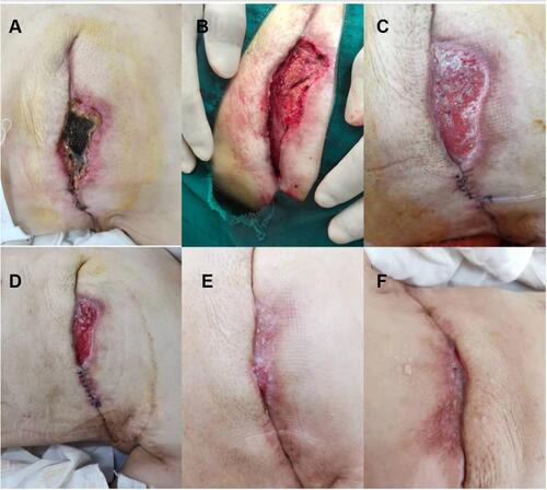 Figure 1 Typical case I. (A) On physical examination, there was purulent secretion at the incision, and the wound skin was completely defective. (B) The suturable part was sutured. (C) Larger scar tissue might be formed in this area. (D) It was recommended to perform the second microgranular skin grafting surgery. (E and F) The wound is completely healed.