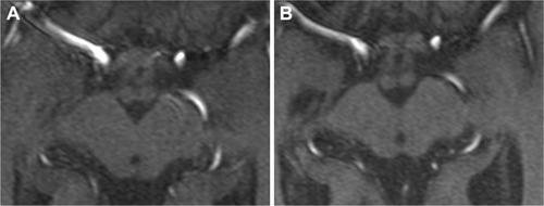 Figure 1 Multiplan reconstructions of 3D time-of-flight MRA images in transverse plane at the superior collicular level. (A) The first MR examination, (B) follow-up 2 years later.