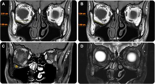 Figure 3 Postoperative follow-up magnetic resonance imaging of the globes. Multi-sequential coronal planar images of the orbit, including plain T1 weighted imaging (A, B); T1-weighted imaging with contrast and fat saturation (C); and T2-weighted imaging (D). These images demonstrate the status after right orbital floor oculoplasty and inferior orbital wall PMMA implant placement (*) with interval complete sealing of the prior fracture. The placed implant measures 1.69 cm × 1.9 cm (A and B) and can be seen covering nearly the entire inferior orbital wall [2.8 cm] (A). The implant is seen subjacent to the inferior rectus muscle with satisfactory attachment to the right inferior orbital wall and adequate fat spacing from extraocular muscles. No significant asymmetry is observed in orbital muscles bilaterally, nor are there signs of an inflammatory process.