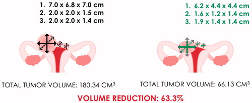 Figure 2. Patient 2 – uterine fibroids before and after treatment.