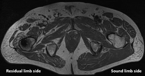 Figure 2. Transverse plane MR image at baseline. Note: the presence of severe adipose tissue on the residual limb side compared to the sound side.